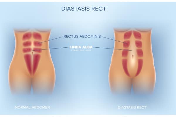 What Non-Surgical Options Are Available for Diastasis Recti Henley-on-Thames?