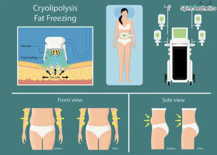 Fat freezing treatment Henley-on-Thames benefits for competitions to remove stubborn fat deposits.