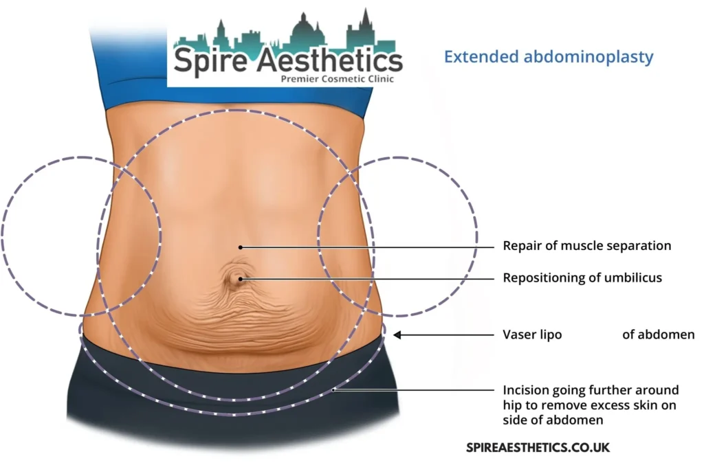Understanding Loose Skin After Gastric Band Henley-on-Thames Surgery and HIFU Treatment