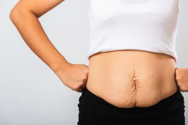 Image of a woman's stomach after weight loss with sagging skin following a gastric band Henley-on-Thames