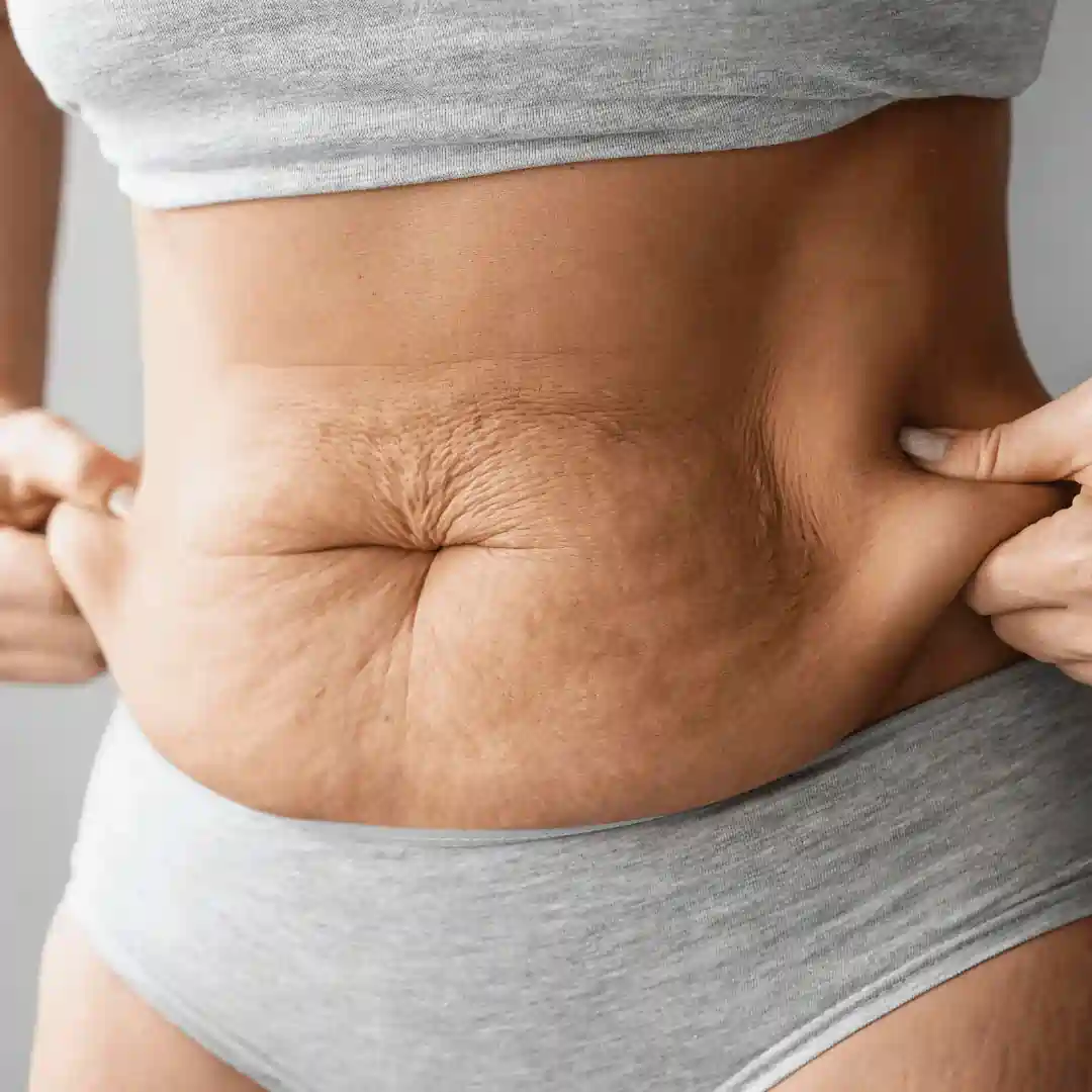 Is It Normal to Have Loose Skin After Pregnancy Henley-on-Thames?