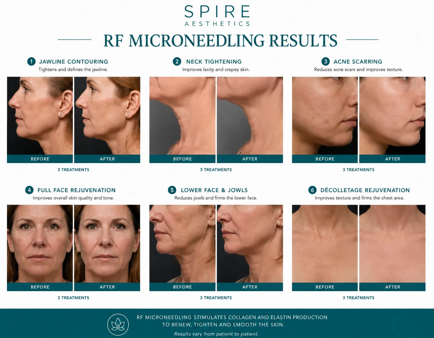 RF Microneedling Skin tightening Henley-on-Thames results