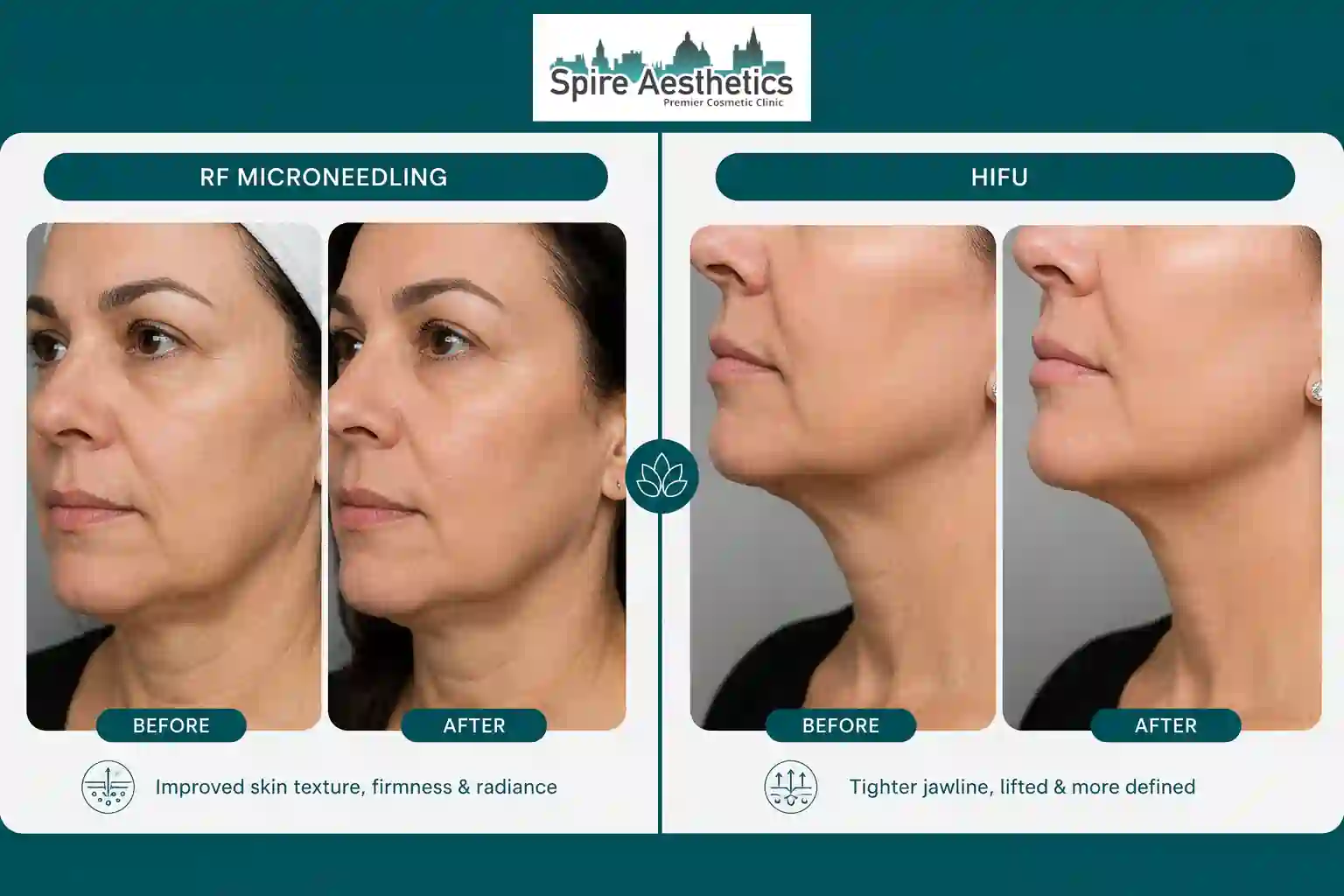 Can RF Microneedling and HIFU Be Combined Henley-on-Thames?
