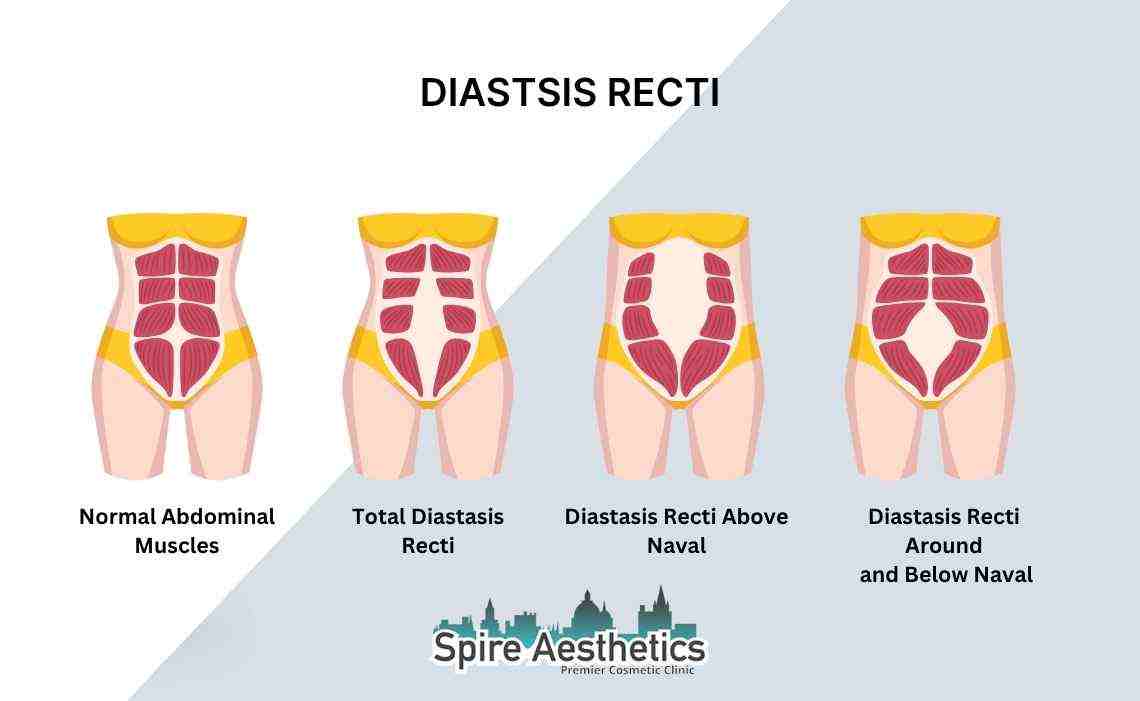 Is Non-Surgical Diastasis Recti Treatment Right for You? Common Concerns Answered Henley-on-Thames